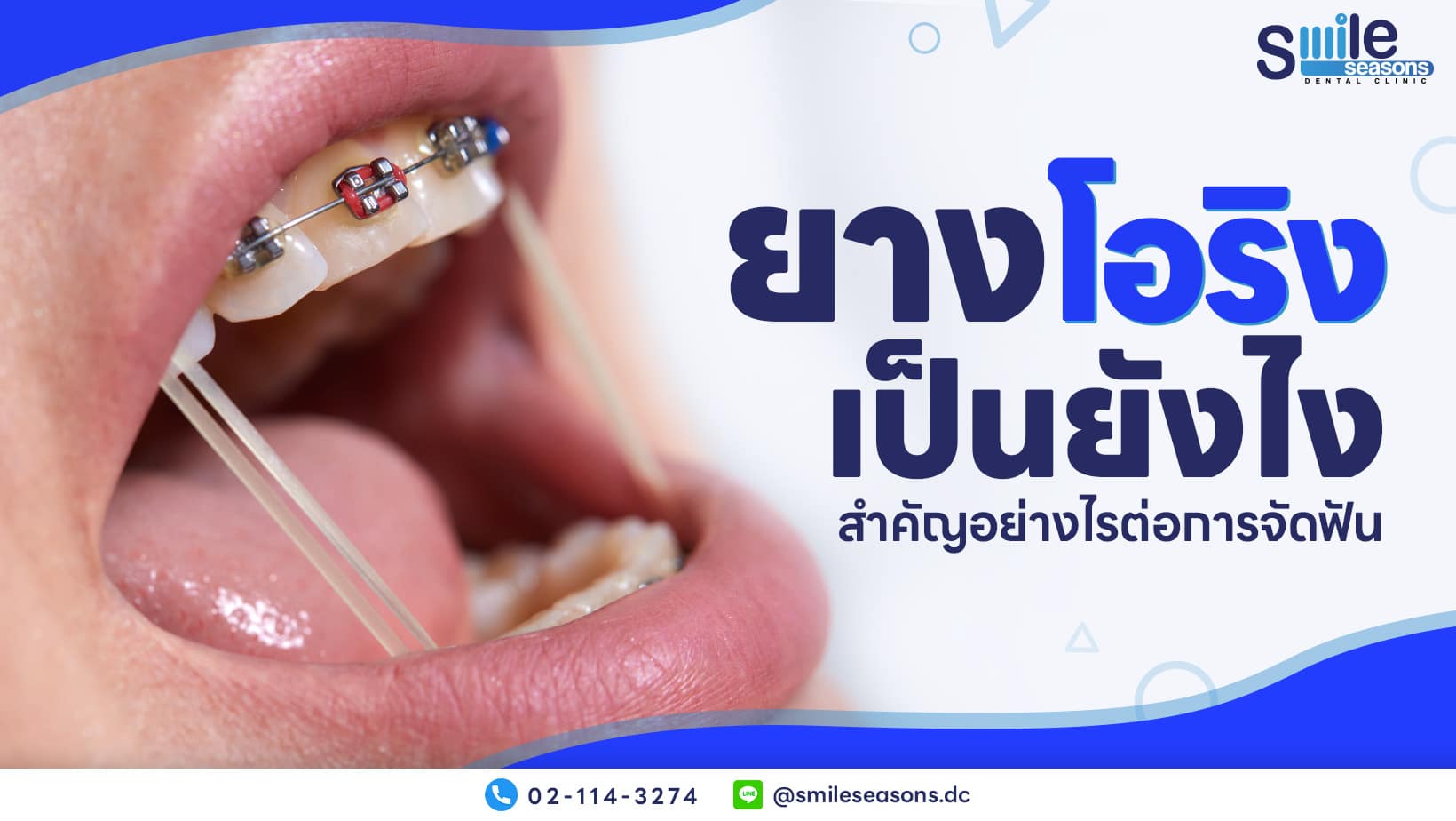 ยางโอริง เป็นยังไง สำคัญอย่างไรต่อการจัดฟัน - Smile Seasons Dental Clinic