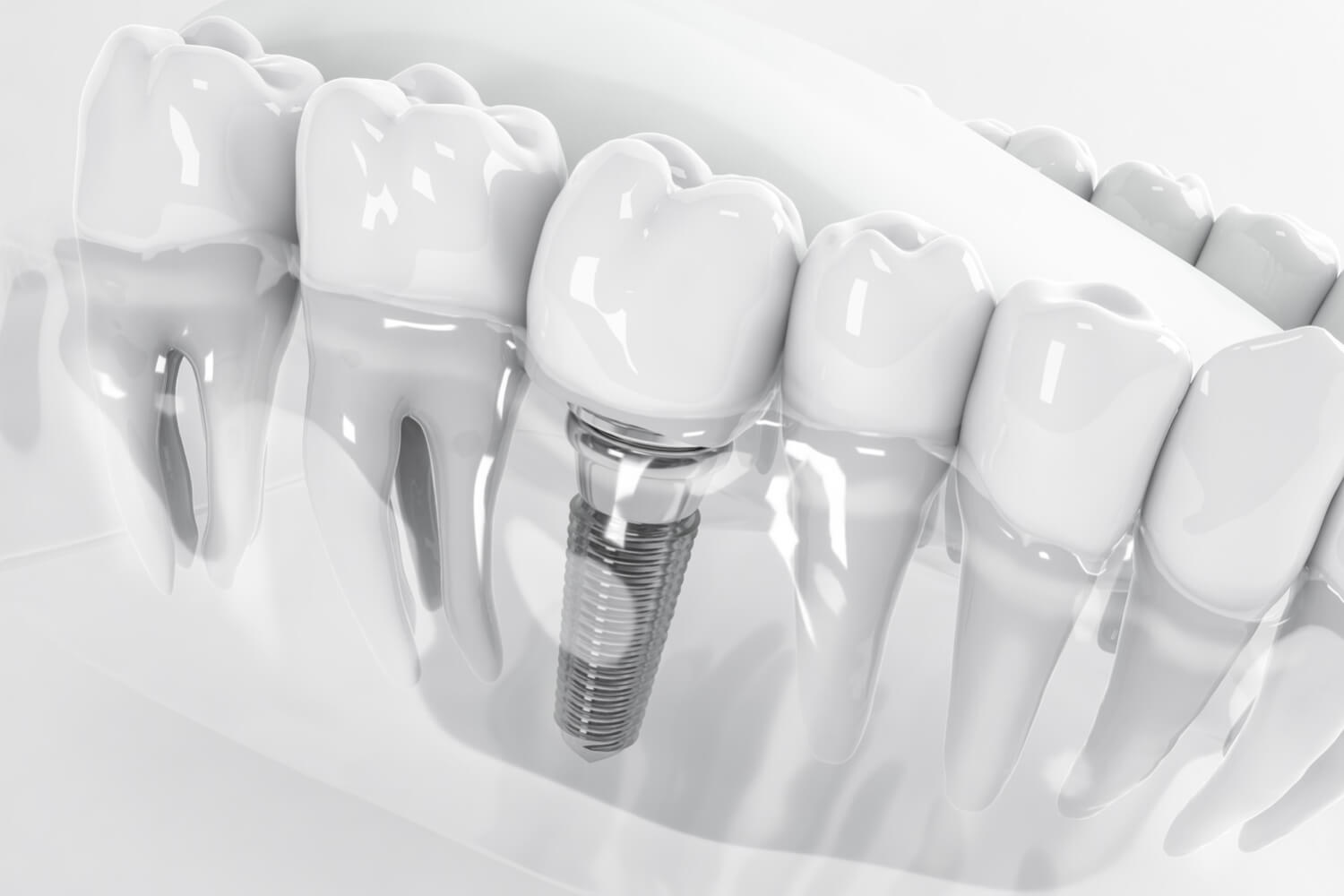 รากฟันเทียม dental implant