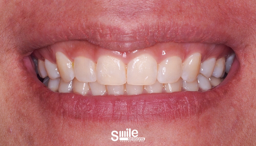 gummy smile 1 Before gummy smile 1 Before