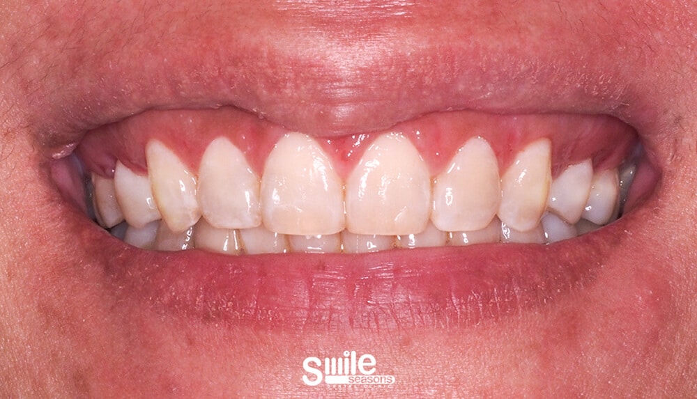 gummy smile 1 After gummy smile 1 After