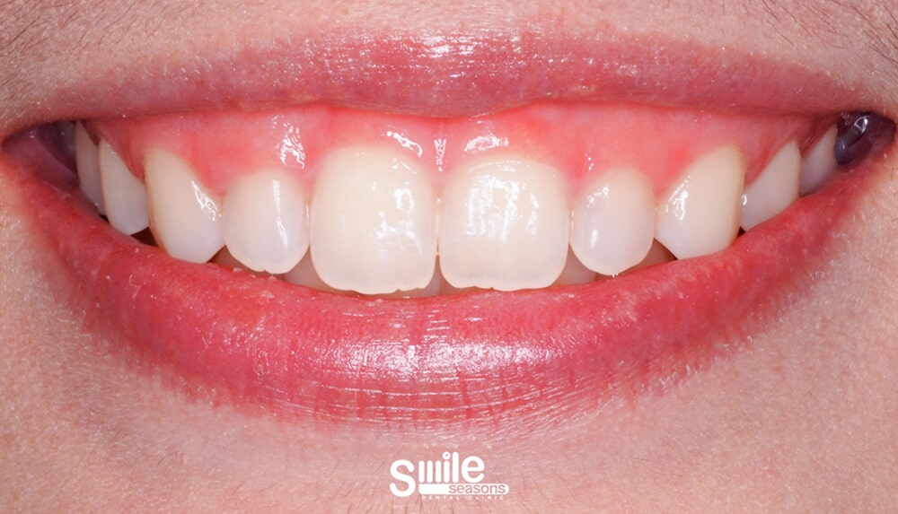 gummy smile 2 Before gummy smile 2 Before