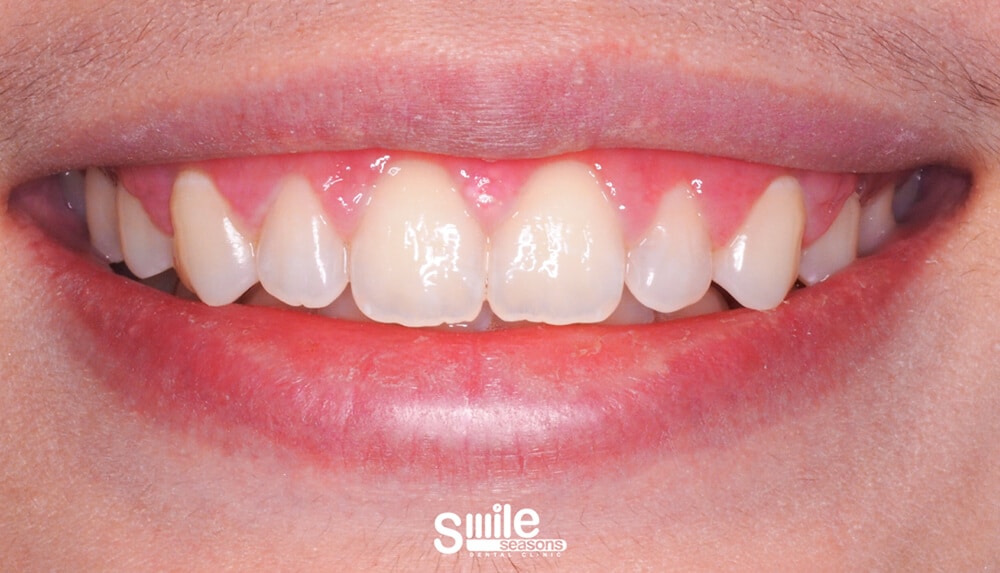 gummy smile 2 After gummy smile 2 After