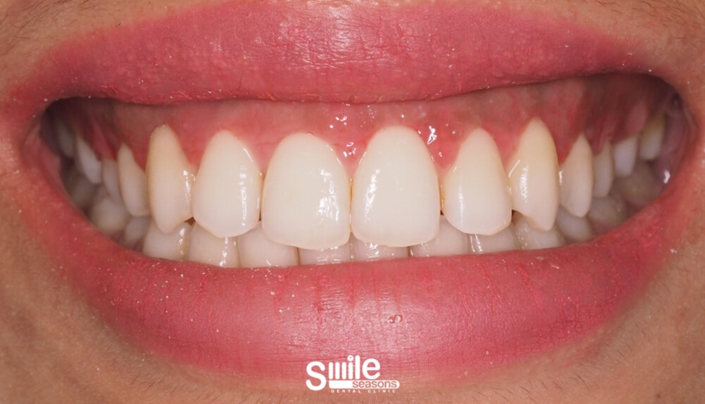 gummy smile 3 After gummy smile 3 After