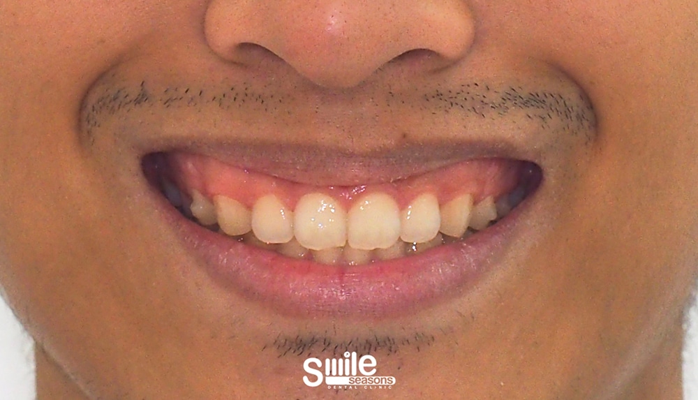 gummy smile 4 Before gummy smile 4 Before