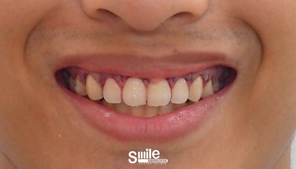 gummy smile 4 After gummy smile 4 After