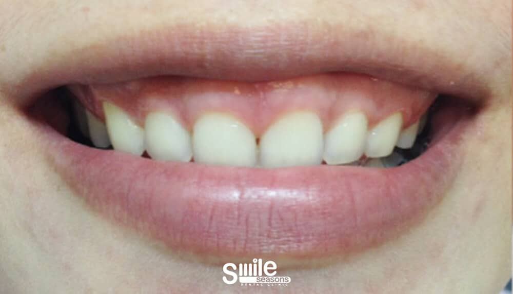 gummy smile 5 Before gummy smile 5 Before