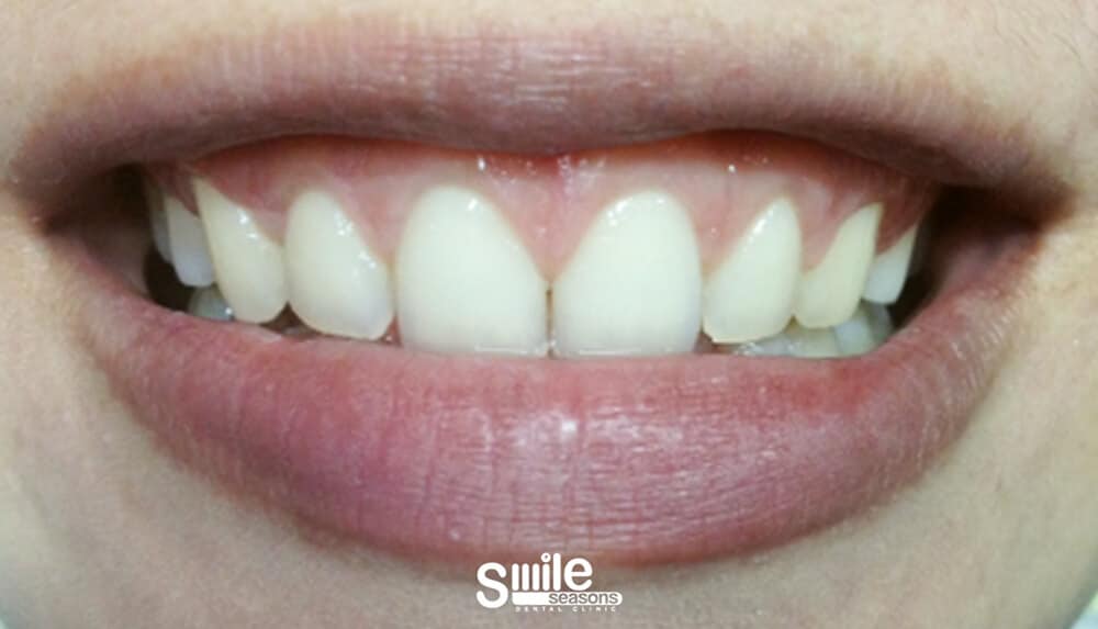 gummy smile 5 After gummy smile 5 After