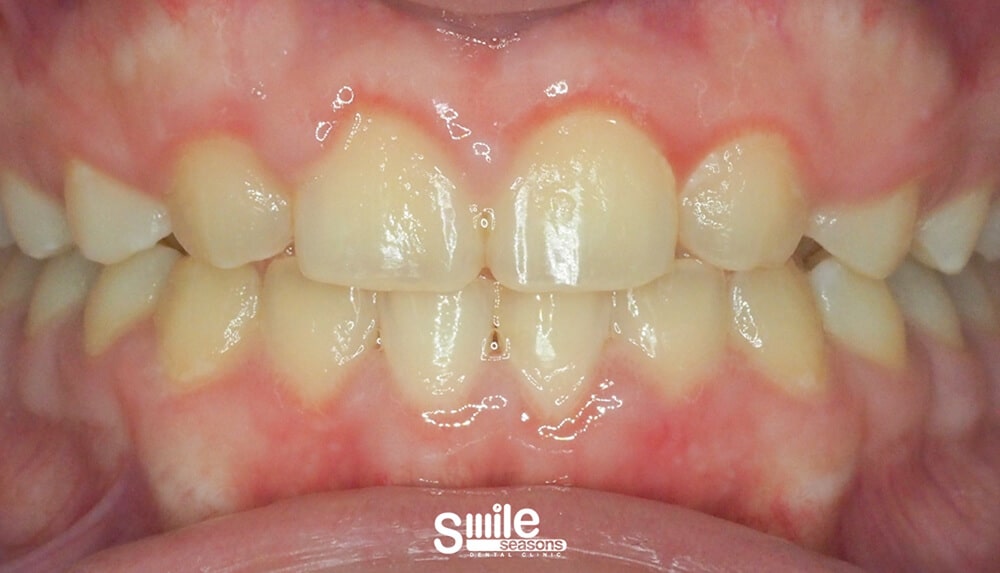 gummy smile 6 After gummy smile 6 After