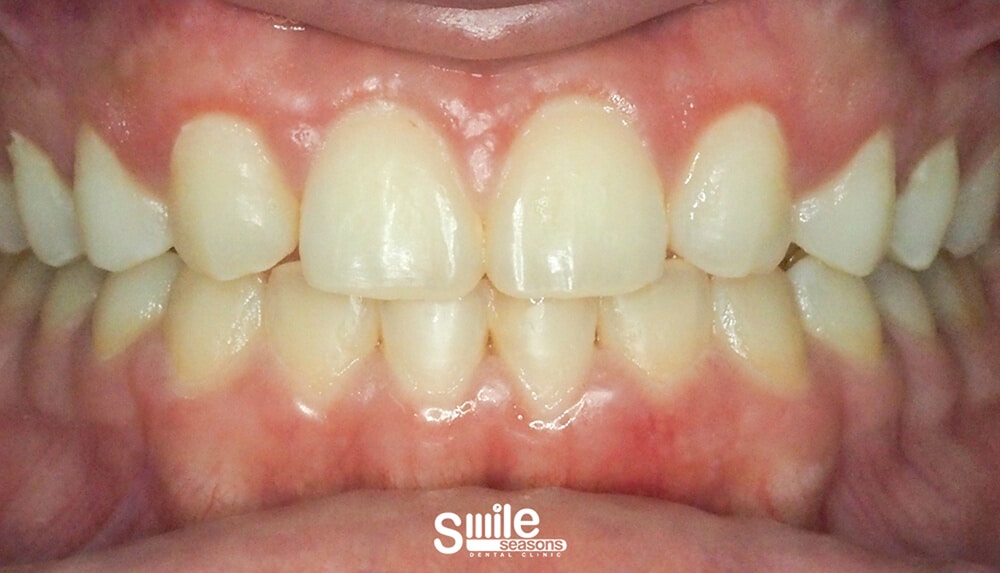 gummy smile 6 After gummy smile 6 After