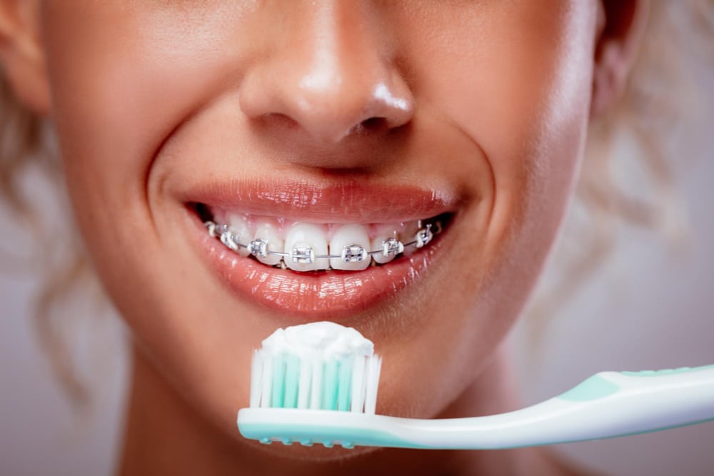 close up smiling woman face with braces white teeth toothbrush