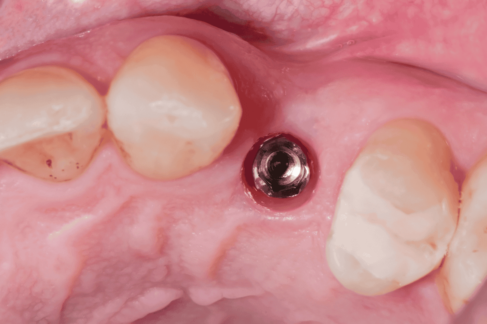 computer-guided dental implant wound