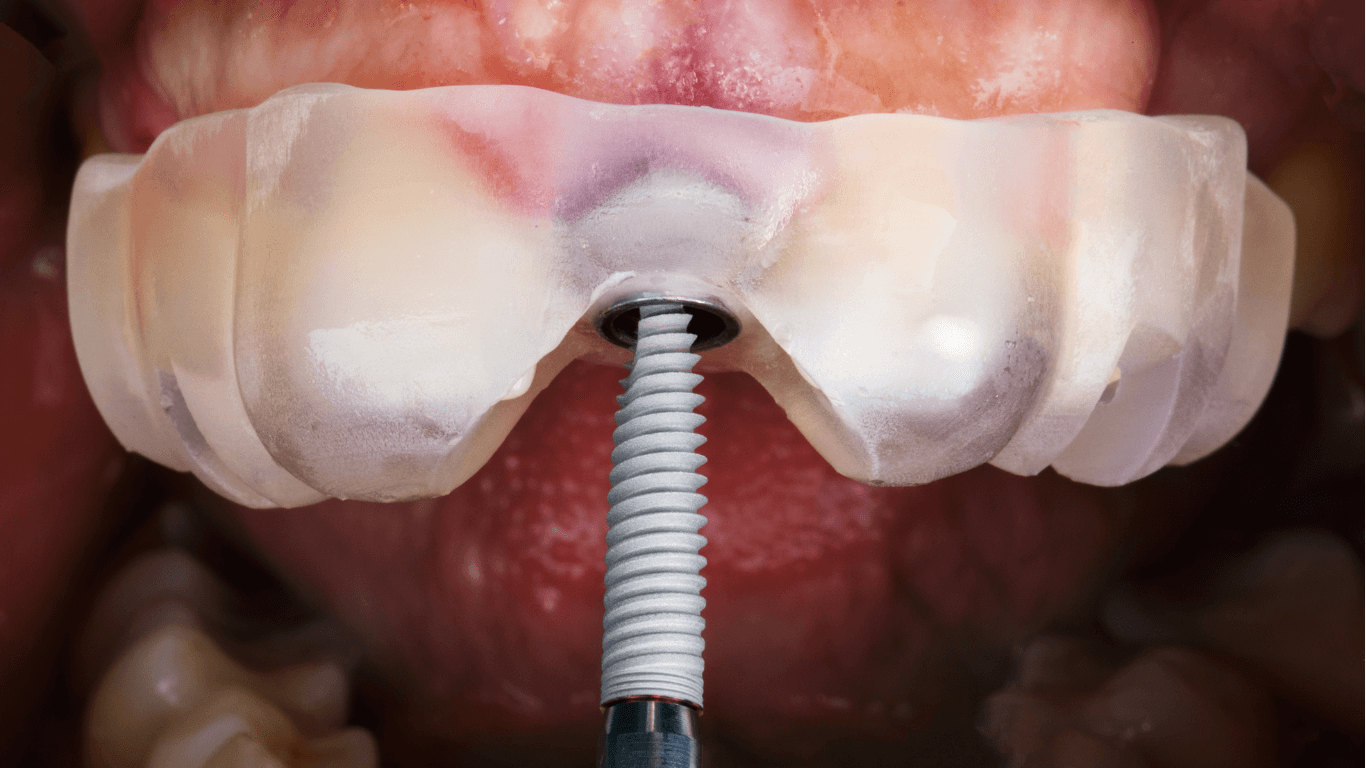 implant surgical guide