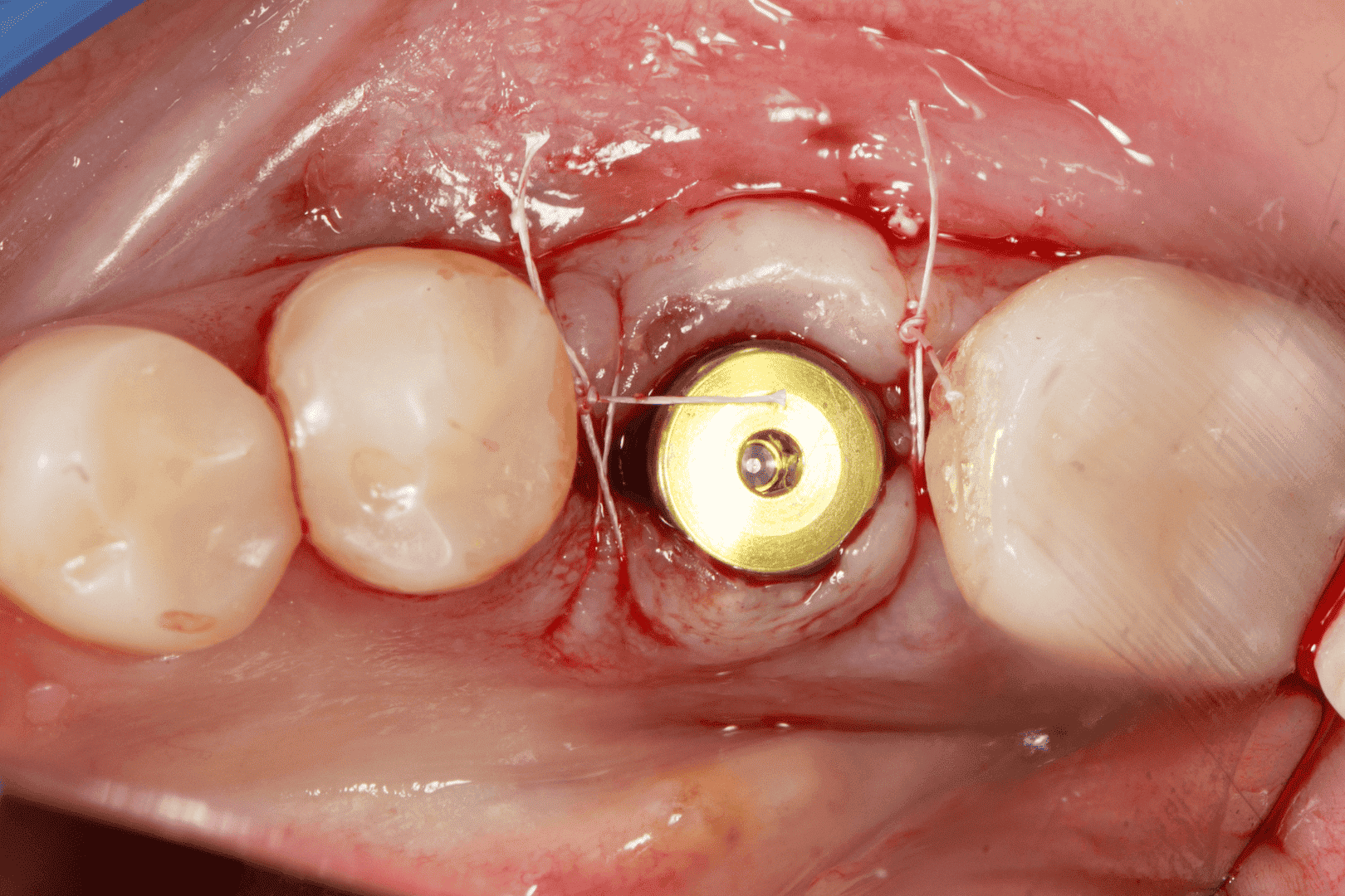 conventional dental implant wound