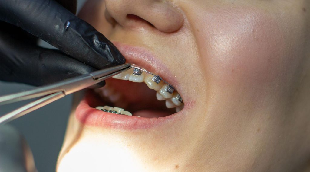 การปรับเครื่องมือจัดฟัน - หากคุณเลือกจัดฟันแบบโลหะ คุณจะต้องเข้ามาพบคุณหมอทุกเดือน เพื่อเปลี่ยนโอริง และลวดจัดฟัน คุณหมอจะตรวจช่องปากด้วยว่ามีปัญหา ฟันผุ หรือหินปูนที่ควรต้องรีบจัดการหรือไม่