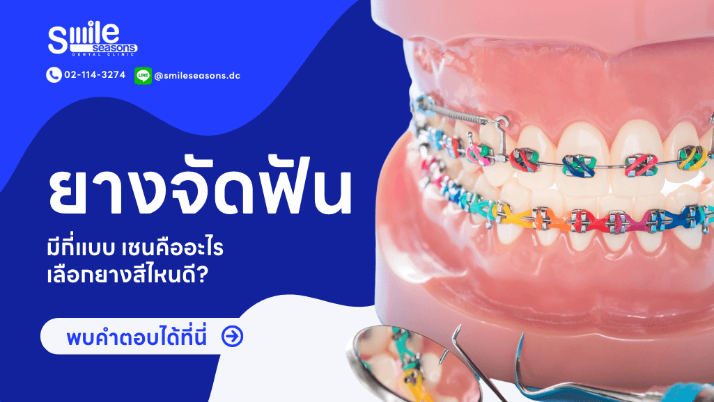 ไขข้อสงสัย ยางจัดฟัน จัดฟันแบบใส่เชน คืออะไร มีทั้งหมดกี่แบบ ? - Smile Seasons Dental Clinic ไขข้อสงสัย ยางจัดฟัน จัดฟันแบบใส่เชน คืออะไร มีทั้งหมดกี่แบบ ? - Smile Seasons Dental Clinic
