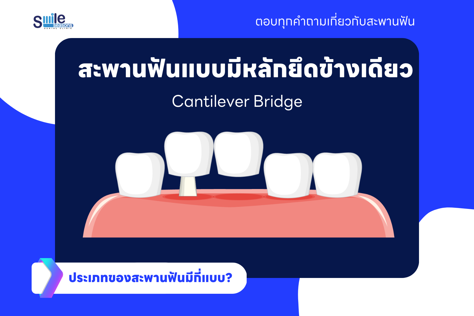 สะพานฟันแบบมีหลักยึดข้างเดียว (Cantilever Bridge)