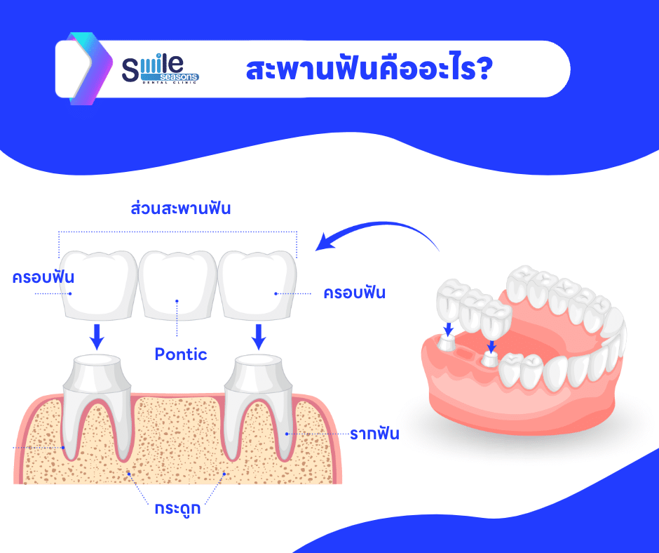 สะพานฟัน คืออะไร