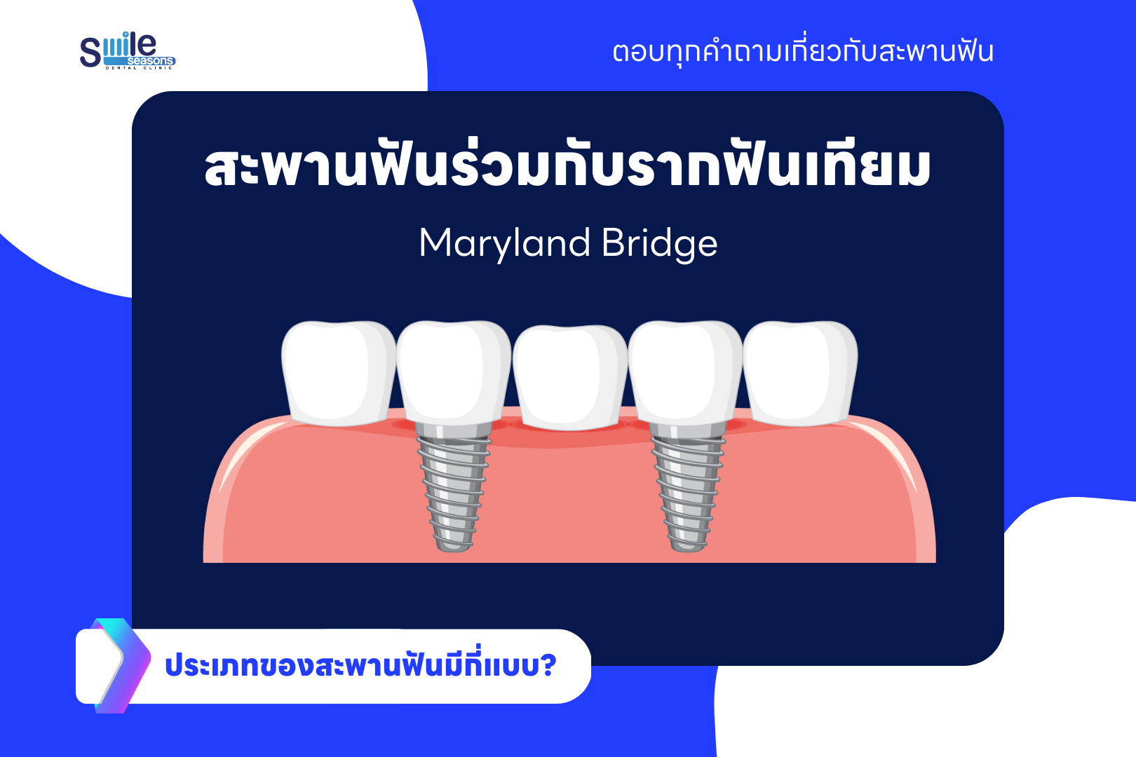 สะพานฟันร่วมกับรากฟันเทียม (Implant-Supported Bridge)