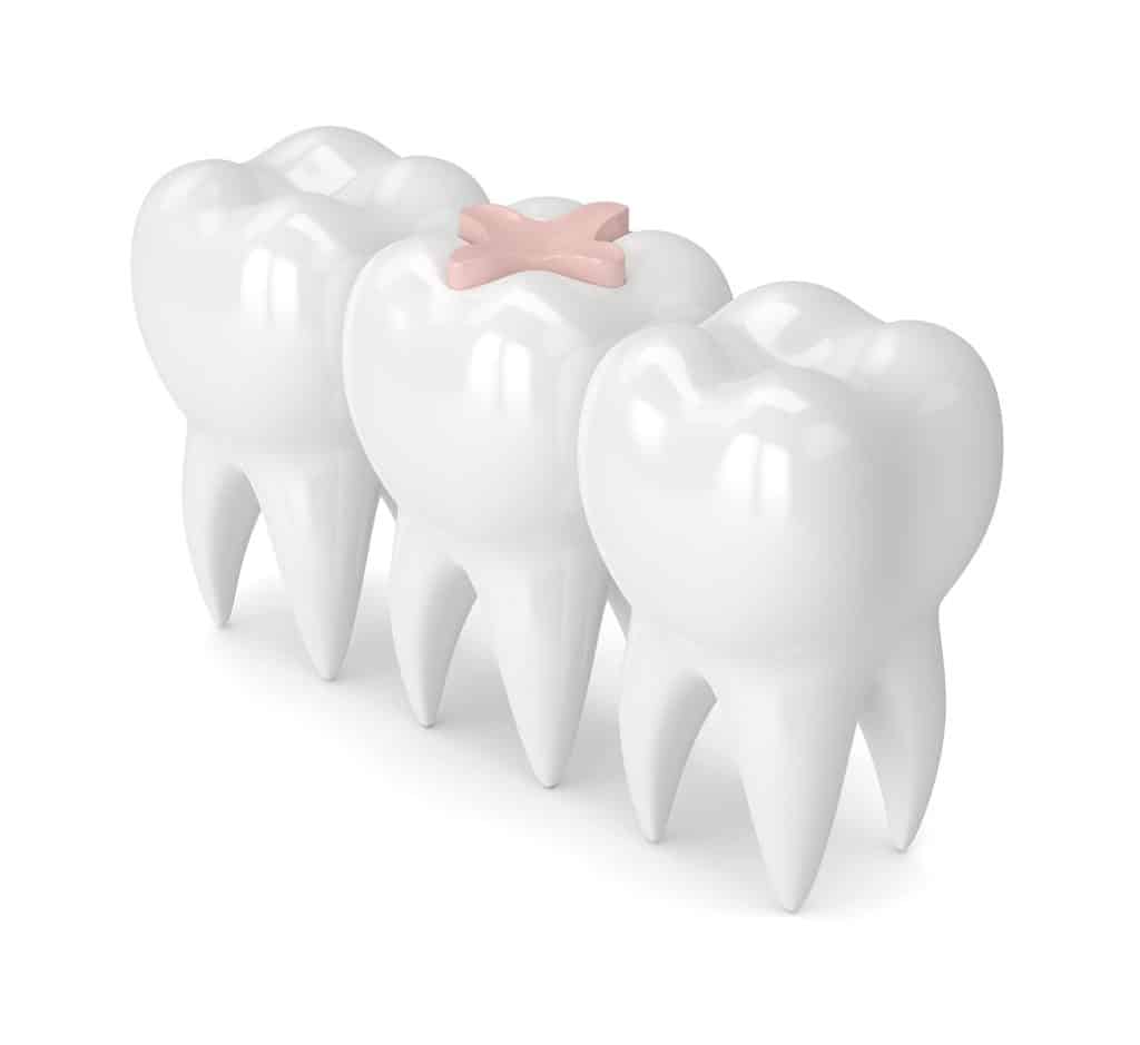 อุดฟันด้วย Glass ionomer (GI)