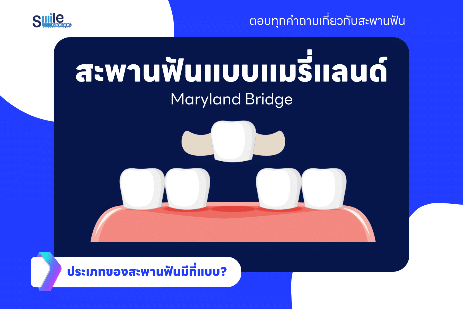 สะพานฟันแบบแมรี่แลนด์ (Maryland Bonded Bridge)