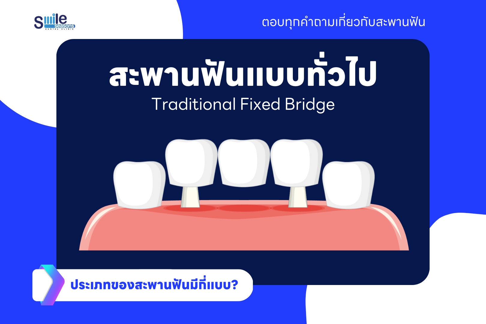 สะพานฟันแบบทั่วไป