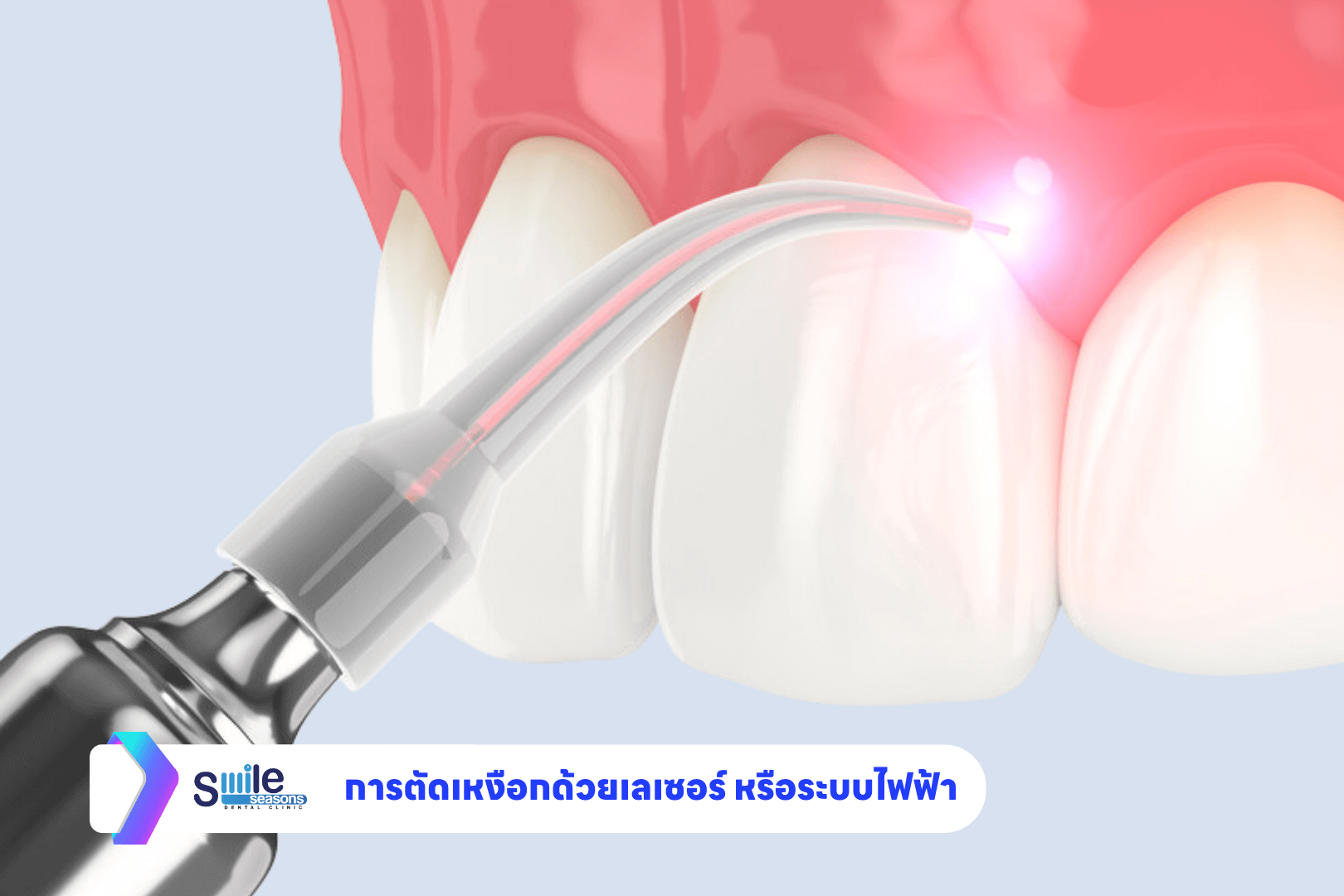 ตัดเหงือกด้วยเลเซอร์ ระบบไฟฟ้า