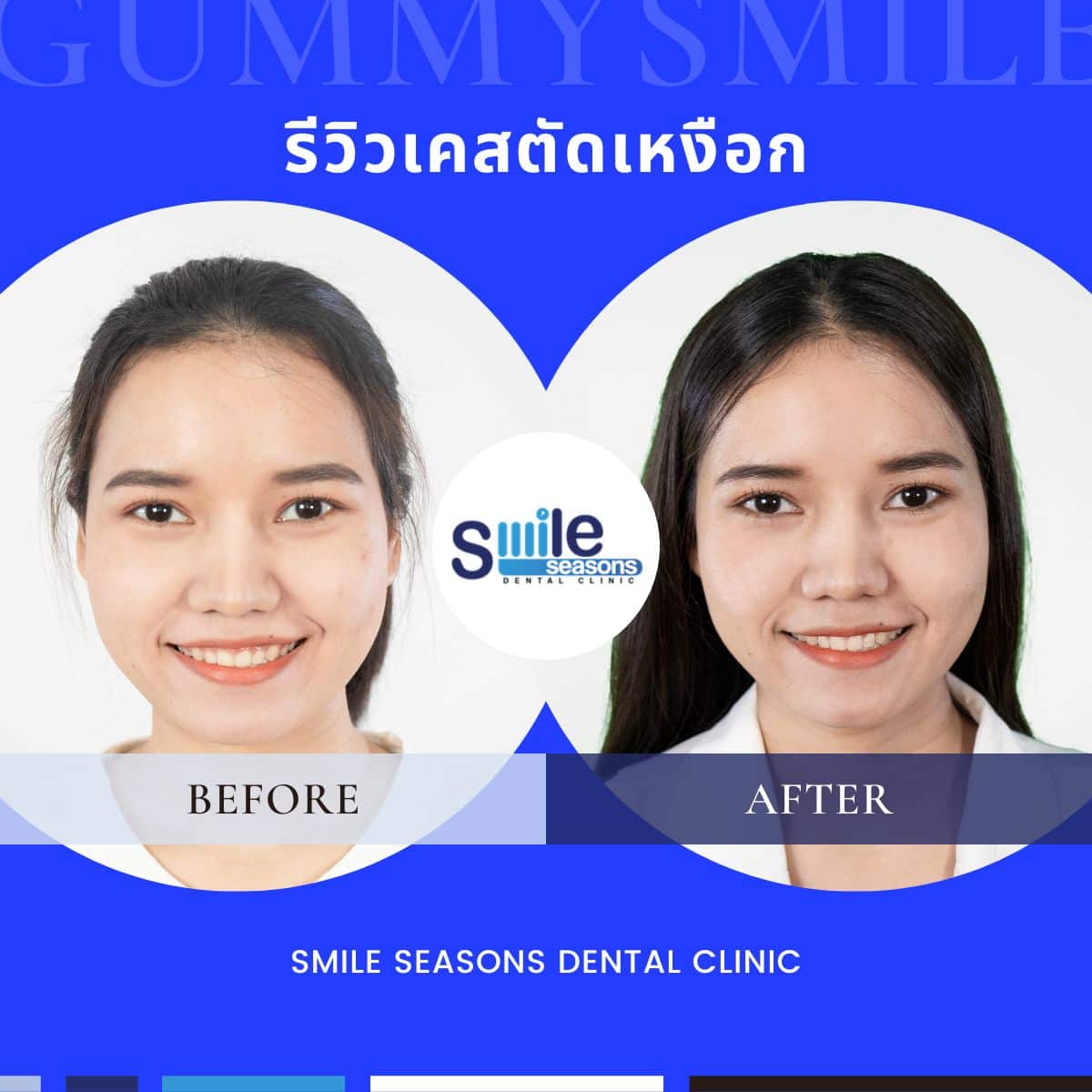 รีวิวตัดเหงือกที่ smile seasons