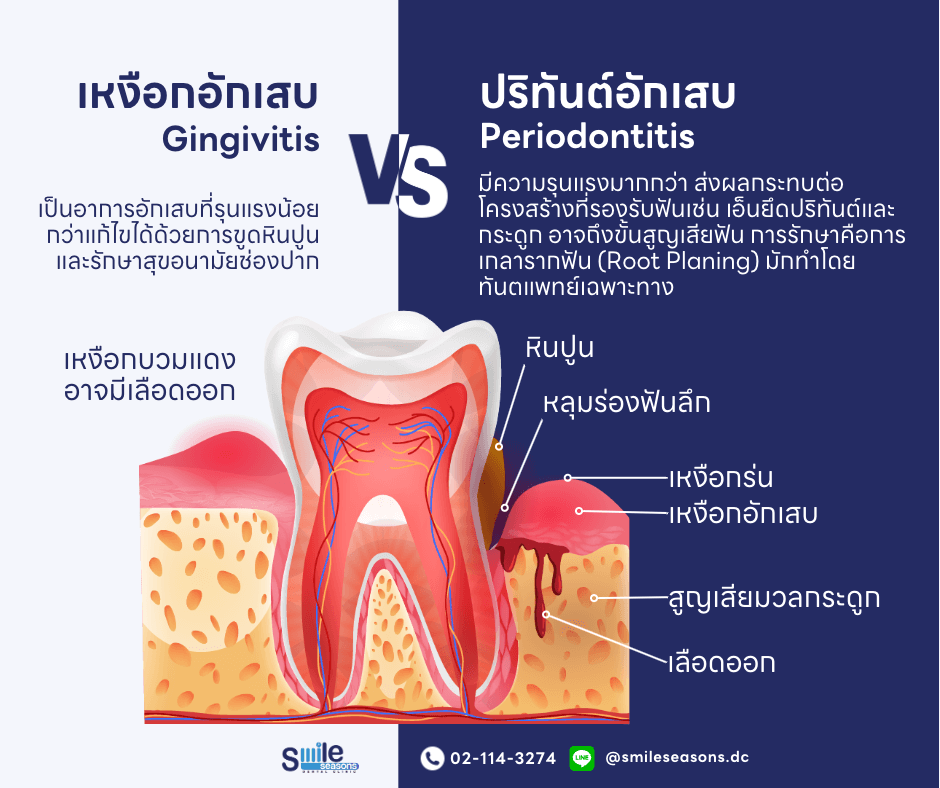 เหงือกอักเสบ เหงือกบวม