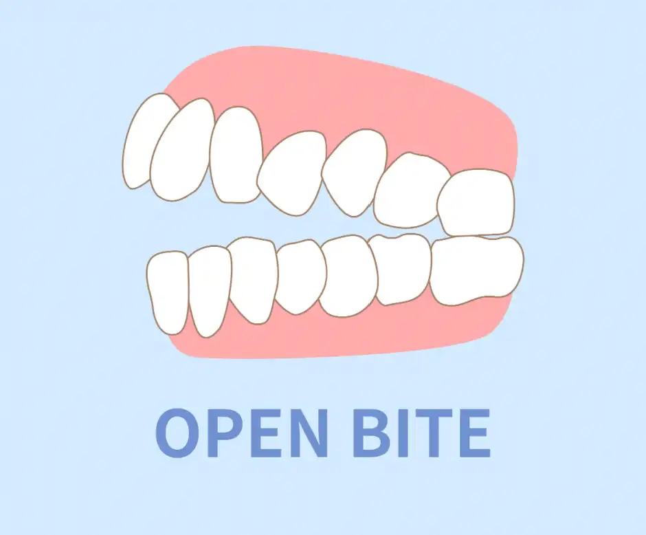 ฟันไม่สบกัน หรือ ฟันสบเปิด (Openbite) คืออะไร