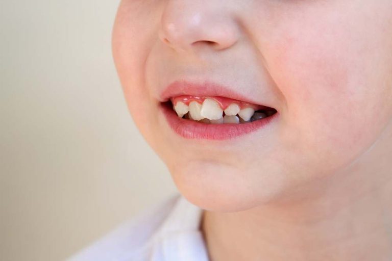 การมีฟันซ้อน นอกจากจะส่งผลต่อสภาพจิตใจในเรื่องของความมั่นใจแล้ว ยังส่งผลต่อสุขภาพภายในช่องปากอีกด้วย ซึ่งปัญหาที่พบได้บ่อยจากการมีฟันซ้อน
