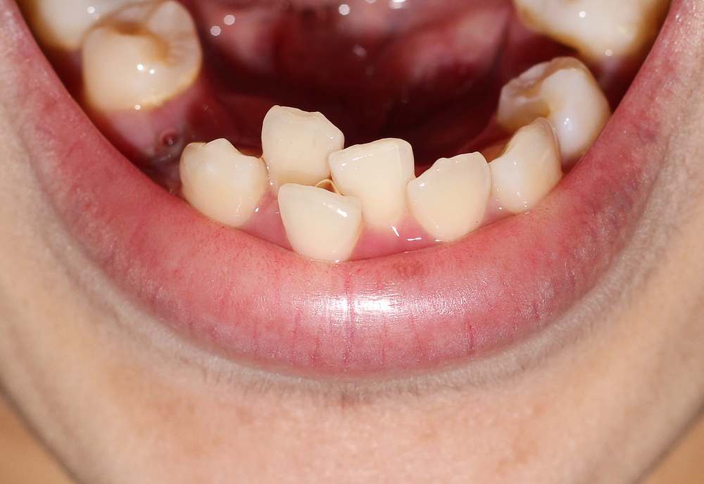 ฟันซ้อน ไม่จำเป็นต้องถอนฟัน แต่ทั้งนี้จะขึ้นอยู่กับสภาพฟันของแต่ละบุคคลว่ามีความรุนแรงมากน้อยแค่ไหน และขึ้นอยู่กับดุลพินิจของทันตแพทย์ร่วมด้วย