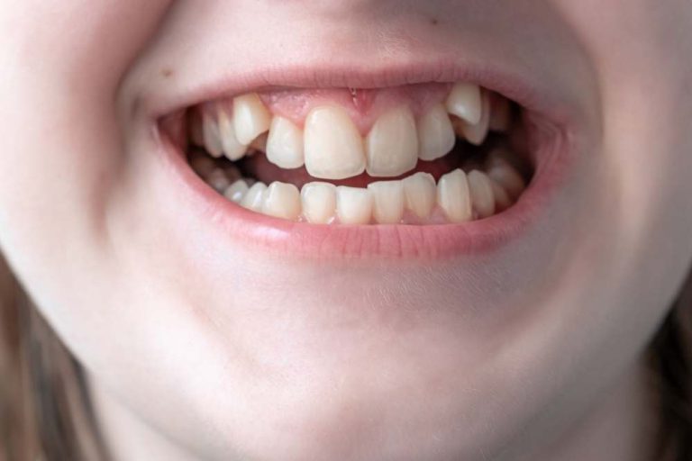 ฟันเก คือ สภาพของฟันที่ขึ้นแบบเรียงตัวกันบิดเบี้ยว มักจะเกิดขึ้นพร้อมกับฟันซ้อน โดยจะเกิดจากฟันที่ขึ้นซ้อน ซึ่งขึ้นเรียงตัวเบียดกันจนส่งผลให้ฟันเกิดการเอนตัวบิดเบี้ยวจนกลายเป็นฟันเกนั่นเอง