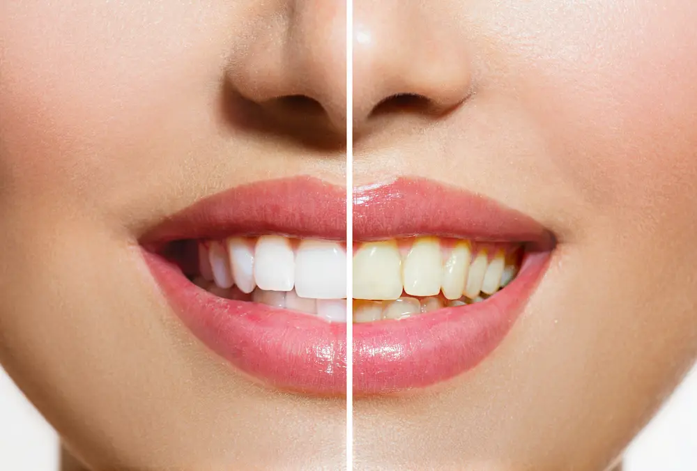 ทำไมฟันของเราถึงเปลี่ยนเป็นสีเหลืองมากขึ้น สาเหตุ ผลกระทบของฟันเหลืองเกิดขึ้นได้ยังไง