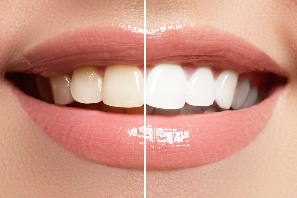 การฟอกสีฟันช่วยให้ฟันของคุณขาว สว่าง กระจ่างใส