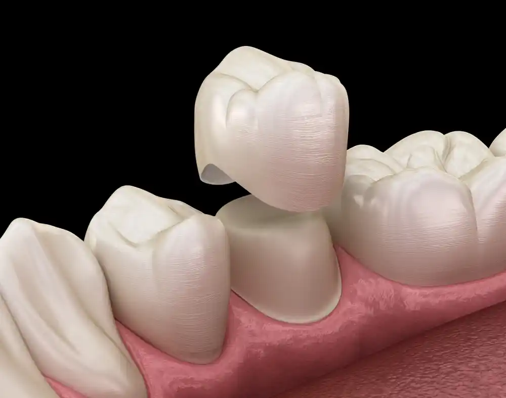 การครอบฟัน มักถูกใช้รักษาภาวะฟันตกกระในระดับรุนแรงที่มีการสึกกร่อนของเคลือบผิวฟันปริมาณมาก
