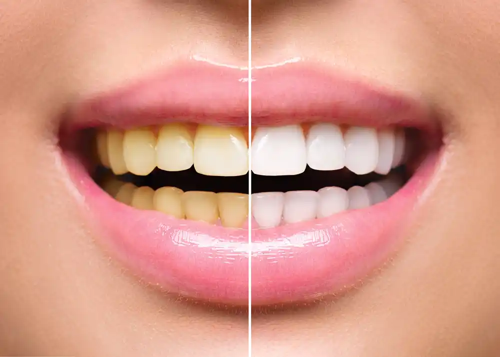 ฟอกสีฟันรักษาฟันตกกระเป็นแบบไหน ราคาเท่าไหร่ มีทั้งหมดกี่แบบ