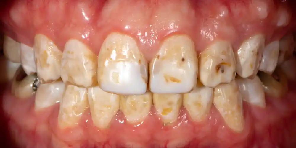 ฟันตกกระ (Dental Fluorosis) เป็นภาวะผิดปกติของฟันที่เกิดขึ้นเมื่อคุณได้รับสารฟลูออไรด์ในปริมาณมากเกินไป ในระหว่างการพัฒนาของฟัน