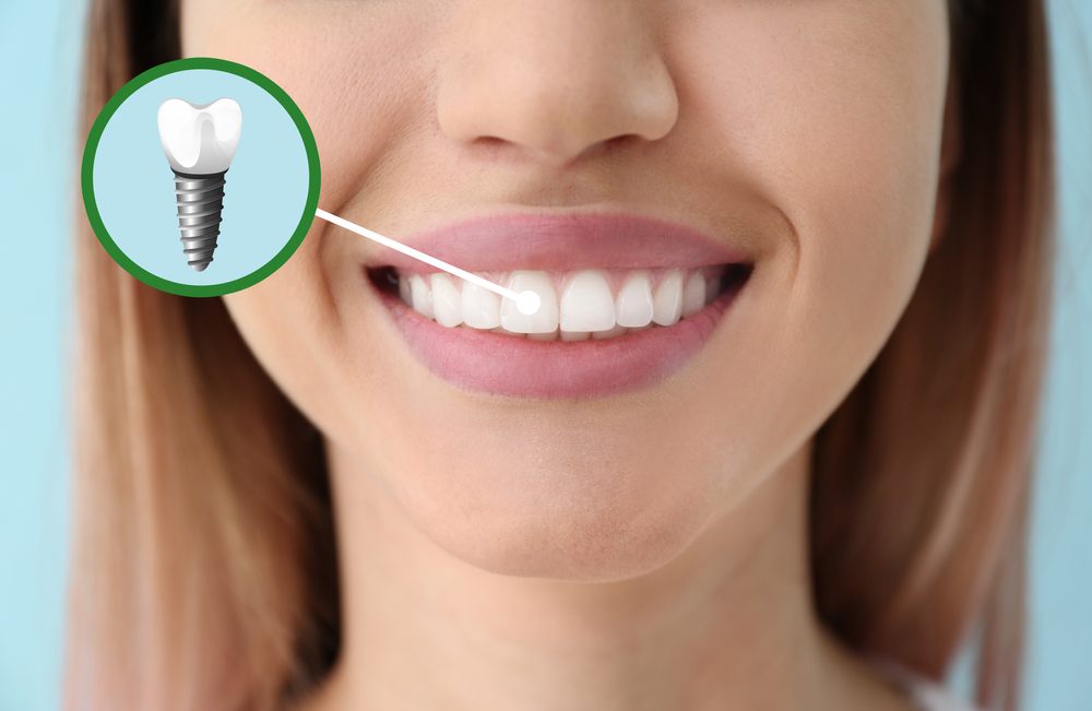 รากฟันเทียมหรือ Dental Implant คืออะไร
