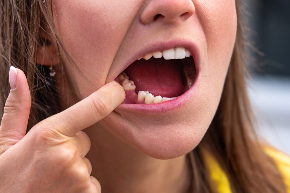 การเลือกแนวทางการรักษาฟันผุที่ทะลุถึงโพรงประสาทฟัน จะขึ้นอยู่กับความรุนแรง และพื้นที่ของการอักเสบติดเชื้อ