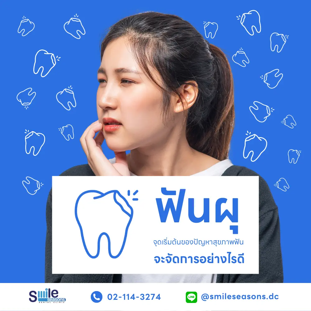 ฟันผุ จะจัดการอย่างไรดี dental caries FM