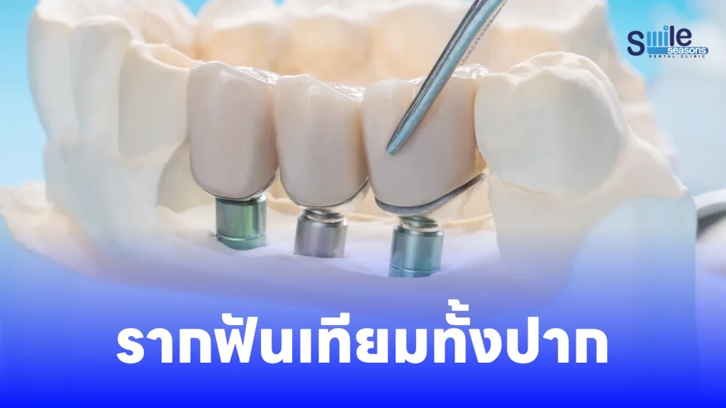 รากฟันเทียมทั้งปาก | Smile Seasons