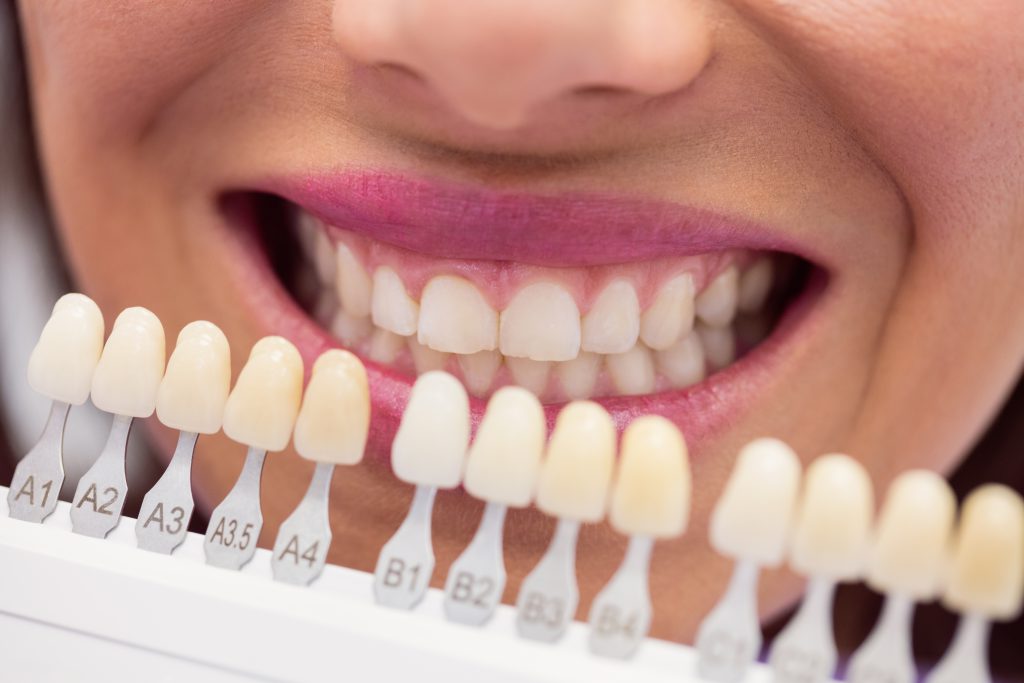 Veneers