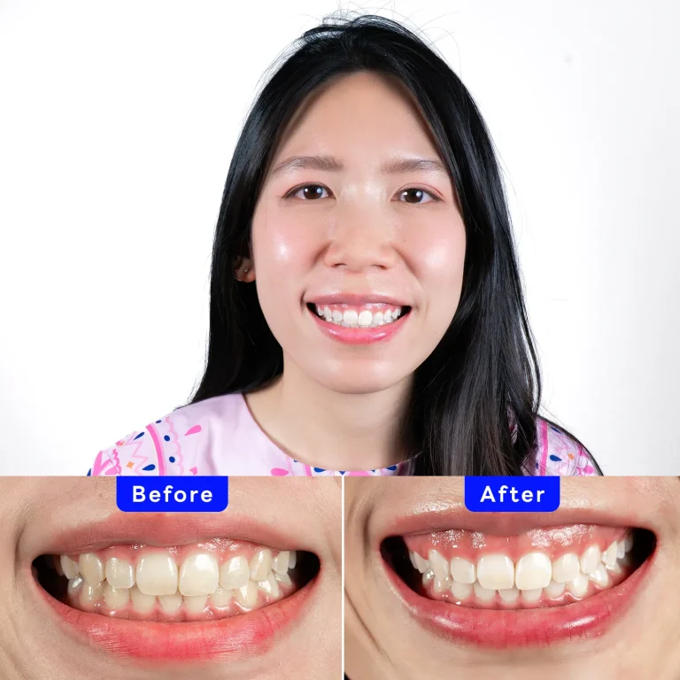 Zoom! Patient Case - Chatchanok