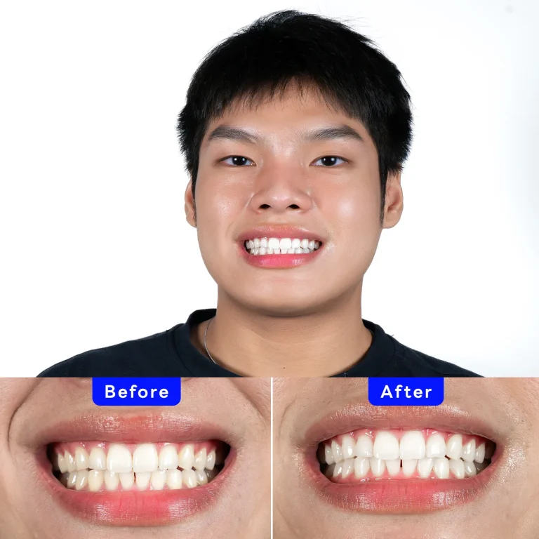 Zoom! Patient Case - Pasapong