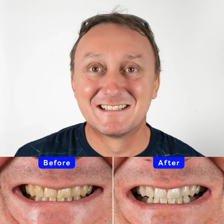 Zoom! Patient Case - Pierre