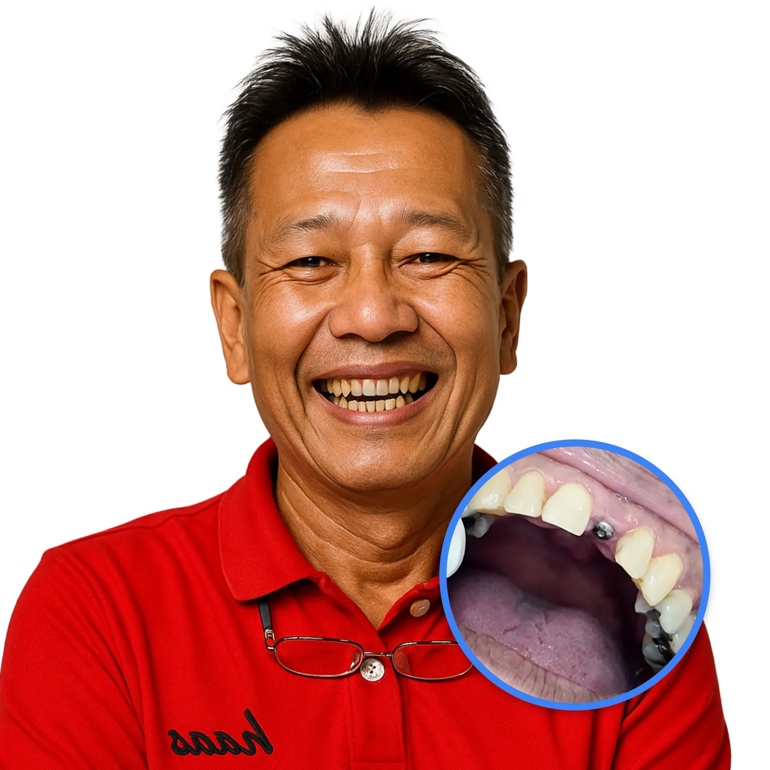 เคสรากฟันเทียม คุณต่าย