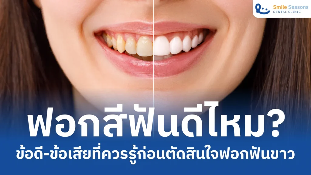 ฟอกสีฟันดีไหม? ข้อดีข้อเสียที่ควรรู้ก่อนตัดสินใจฟอกฟันขาว