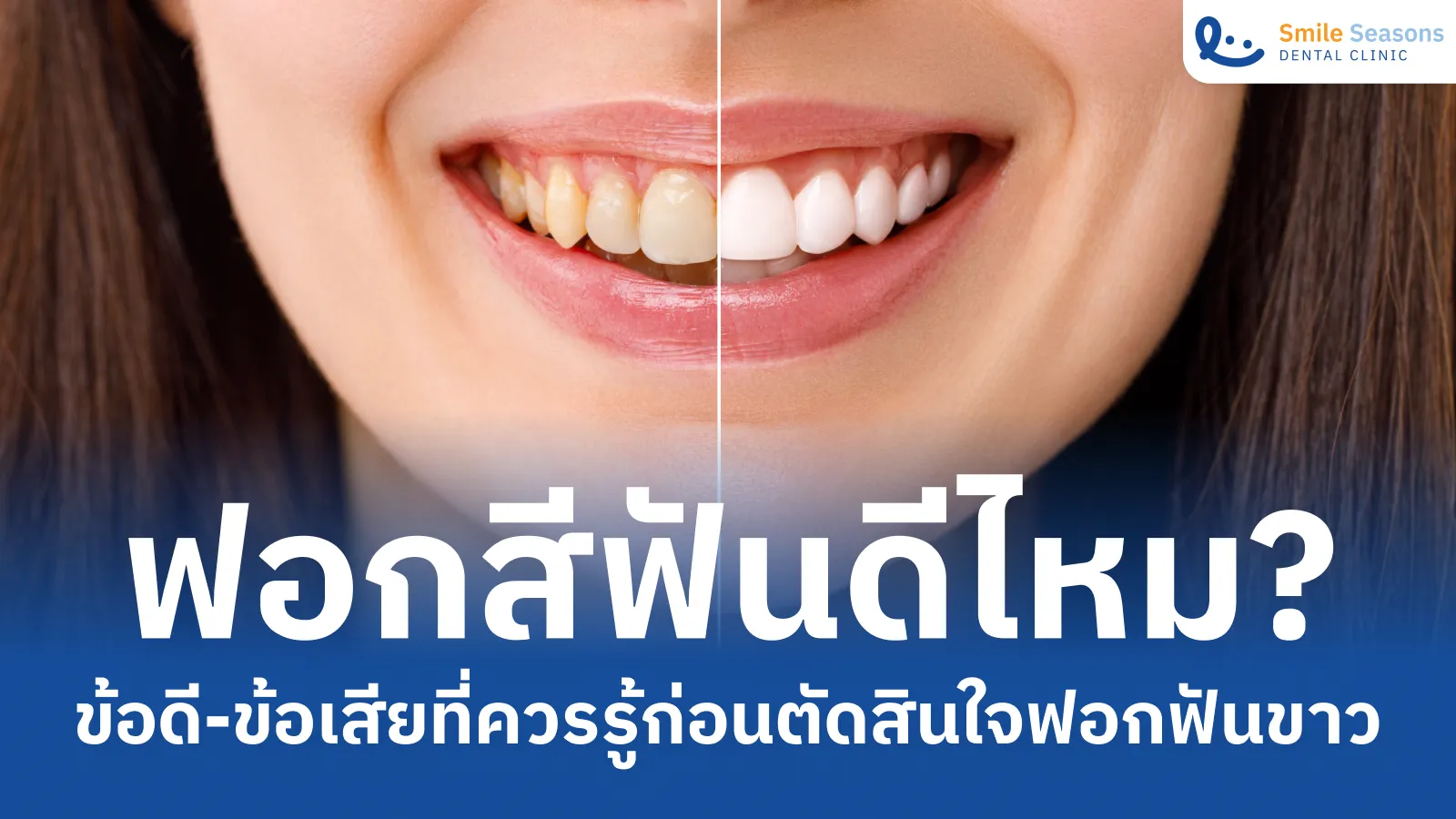 ฟอกสีฟันดีไหม? ข้อดีข้อเสียที่ควรรู้ก่อนตัดสินใจฟอกฟันขาว