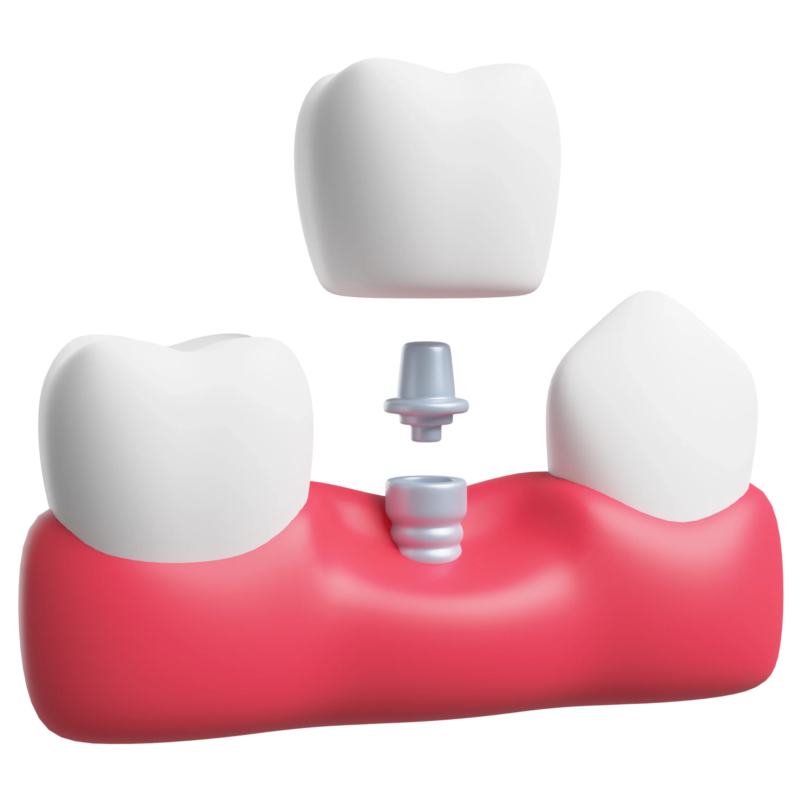 โมเดลรากฟันเทียม