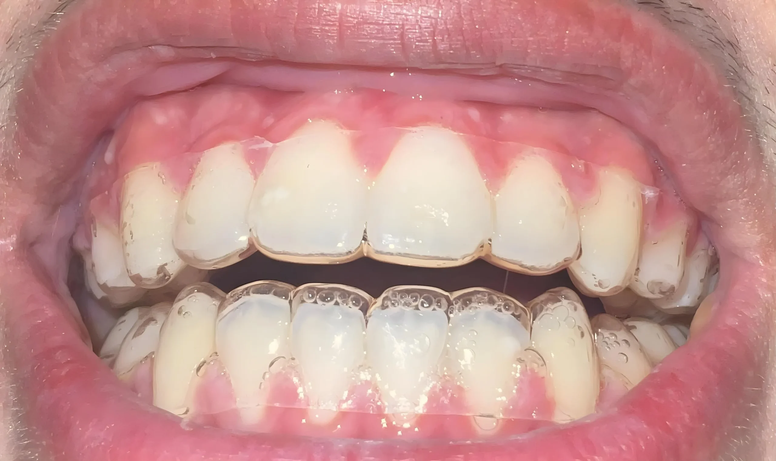 วัสดุทั่วไปที่เกิดช่องว่าง